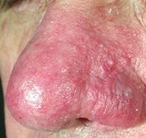 Dermatite Seborroica CRLAB