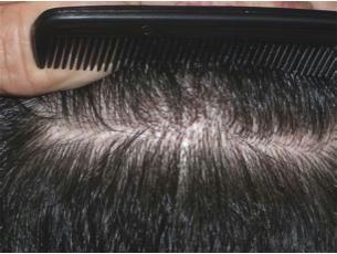 Trapianto e autotrapianto capelli: FUT e FUE CRLAB
