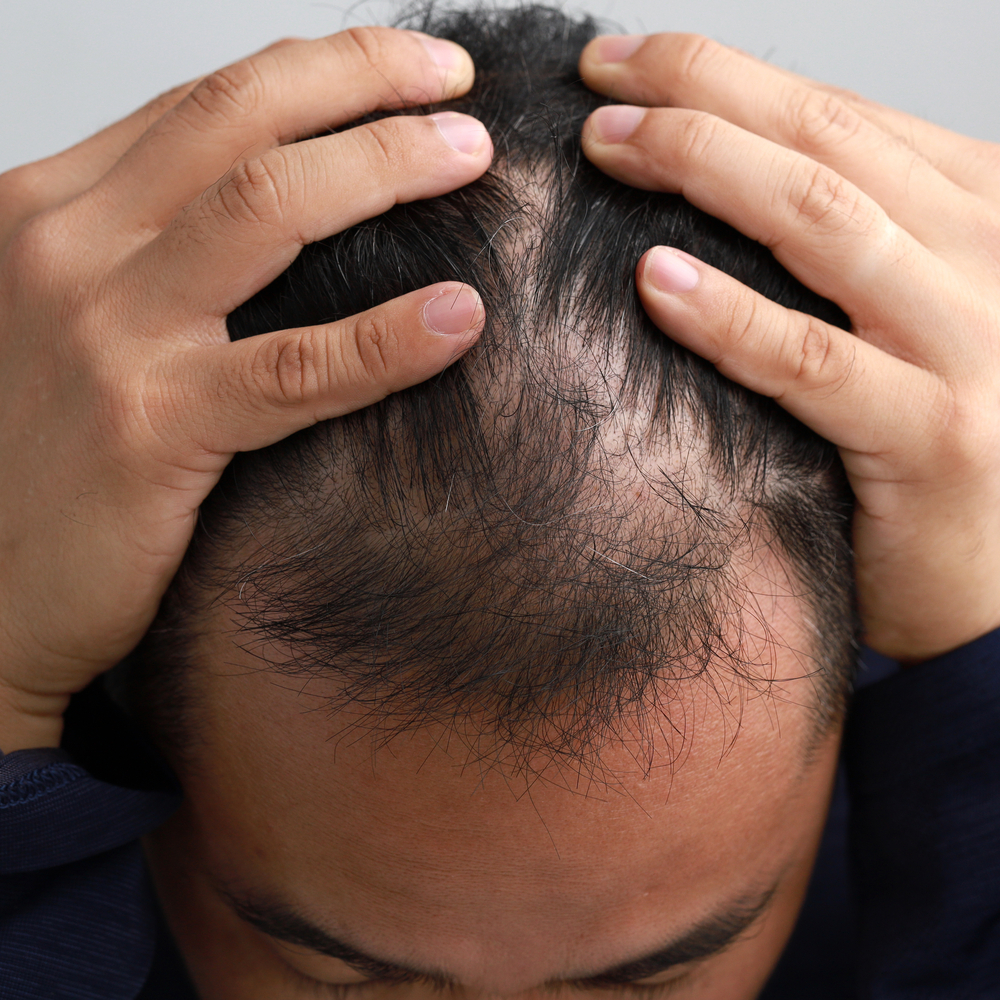 Alopecia da stress o psicogena CRLAB