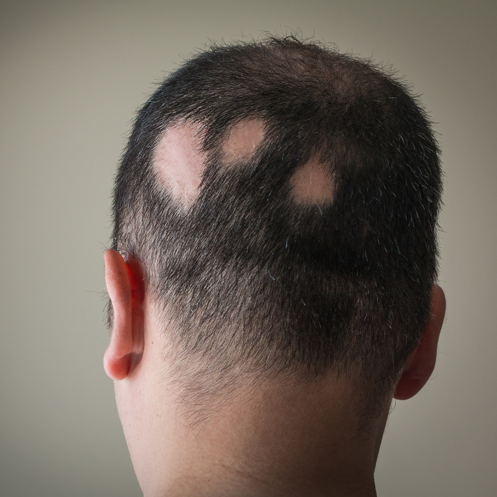 Alopecia Areata CRLAB