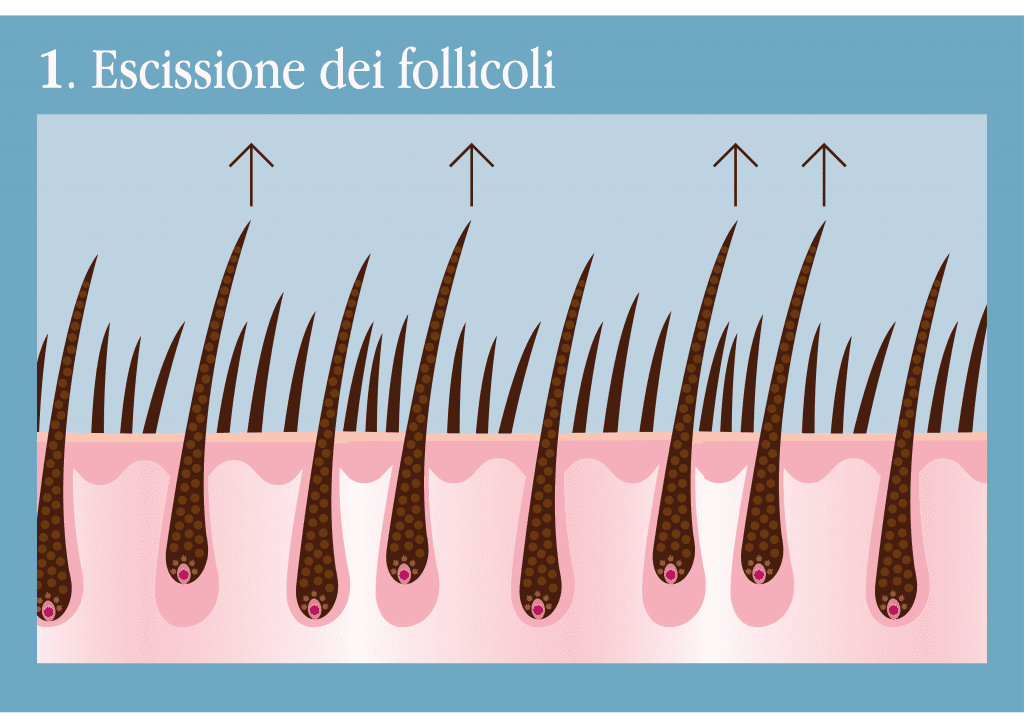 Step 1 - Escissione dei follicoli